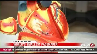 World's Smallest Pacemaker Utilized at Marin General Hospital (KRON4 News, 12/20/17)