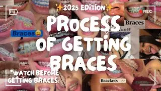 ✨The Process Of ✨GETTING BRACES!✨| TIPS by Katie