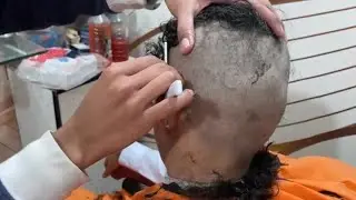 OMG 🥵 Dandruff Flakes Removal & Head Shave 🔥 Full Transformation