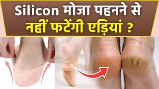 Silicon Socks For Cracked Feet: Dry Feet In Winter Remedy | Boldsky