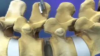 3d surgery animation