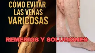 Evita las Venas Varicosas