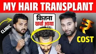 My Hair Transplant Cost, Clinic & Result 🔥🔥🔥 Day 1- 180 Hair Transplant Timelapse 