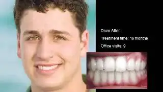 In-Ovation&reg; R Braces