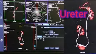 CT Urography full prosesing.