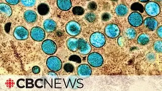 U.S. declares monkeypox a public health emergency