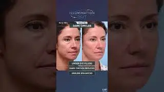Under Eye Refresh with Illumination 360˚