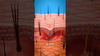 #skincare #splinter #doctor #splintertalk #animation #splint #extraction #satisfying #funny