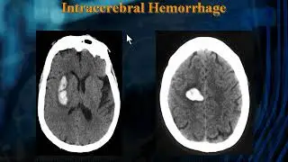 Cerebrovascular Imaging  Which Test and Why by Andrei V  Alexandrov, MD, RVT   S