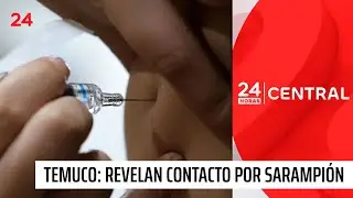 Identifican a contacto del caso de sarampi&oacute;n de la RM en Temuco