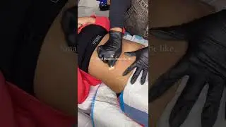 Stretch Mark Treatment In Action!