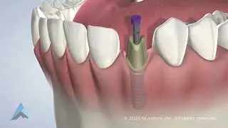 Dental Implants in Boise and Meridian, ID