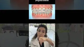 How Can Orthodontic Elastics Help With Your Braces?!