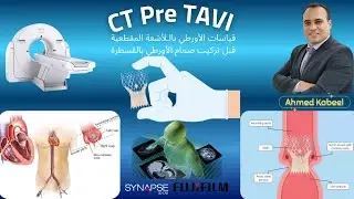 CT TAVI and Aortic Measurements قياسات الأورطي بالـلأشعة المقطعية قبل تركيب صمام الأورطي بالقسطرة