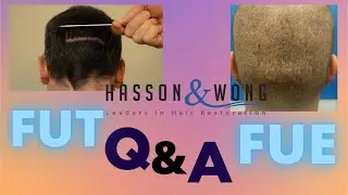FUT or FUE Hair Transplant? *Q&A Hasson and Wong