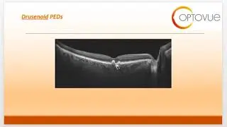 OCT Interpretation Session 5 Subretinal and RPE Disease