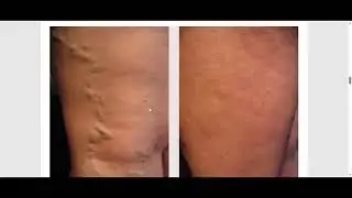 Variflex Krem Sharhlar Uzbekistan: varikoz tomirlari uchun jel! Narxi