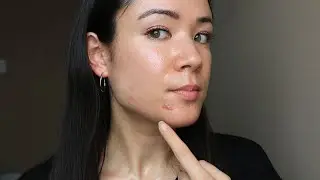 1 Year of Differin - SKIN UPDATE #3 | @michxmash