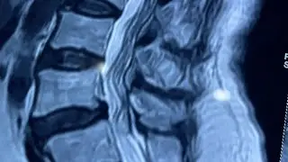 Disc Buldg/ Herniated Disc / Sciatic Nerve Pain / Disc Protusion  Dr Shiv Ram Chaudhary 8130158191