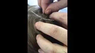 Needling master Tung du 20