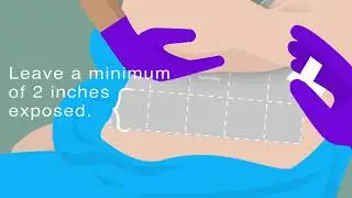 How to apply InterDry moisture wicking fabric in skin folds