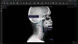 Voyance - Lateral Cervical VPAX Demo