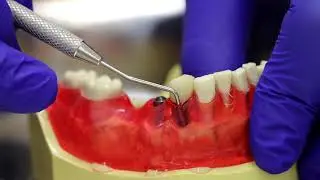 Periodontal probing implants