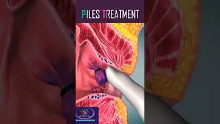 Piles Treatment #shorts #piles