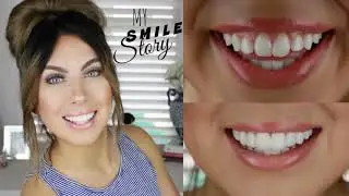 виниры perfect smile veneers инструкция