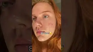 How to pop a pimple without scarring💙  #acneproneskin #acne
