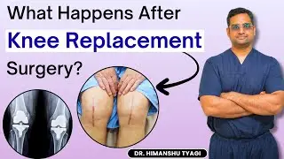 What happens after knee replacement surgery? | TKR / knee arthroplasty/ knee pain /TKA