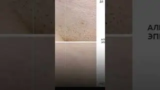 Убрали волосы с помощью лазерной эпиляции зоны бикини Александритовая эпиляция Deka Moveo