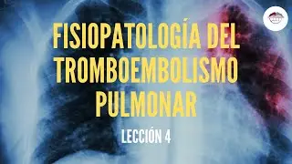 4. FISIOPATOLOGÍA DEL TROMBOEMBOLISMO PULMONAR (FISIOPATOLOGÍA RESPIRATORIA)