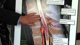 NC Car Accident Destroys Spine - Paralyzed From Chest Down