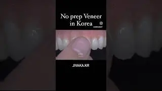 No prep dental Veneers in Korea #laminate #korea #dental