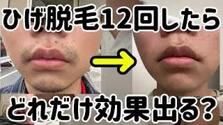 【ヒゲ医療脱毛】12回したらどれだけ効果出る？【1週間写真撮って比較してみた】