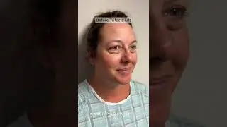 Selfie Update! 4 Months After Trifecta Lift with Dr. Kami Parsa | Puffy Lower Eyelid Treatment