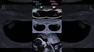 Baby boy, baby girl, RAMZI THEORY, ultrasound #baby #babygirl #shorts