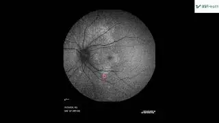 Syphilitic Chorioretinitis -  Grant Slagle - 2024 11 09