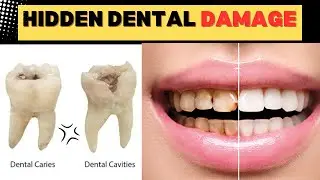 The Hidden Condition Causing All Your Cavities (Stop It Now!)
