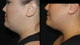 NO MORE DOUBLE CHIN - CoolSculpting Mini Treatment to the Chin with Tanya Patron, PA-C