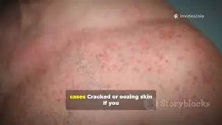 Intertrigo: Causes, Symptoms, and Effective Treatments for Skin Fold Rashes&rdquo;