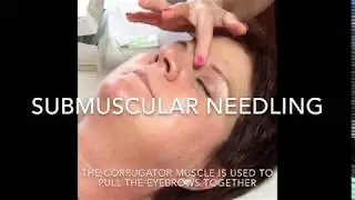 Michelle Gellis teaches acupuncture needling of corrugator muscle for facial cosmetic acupuncture