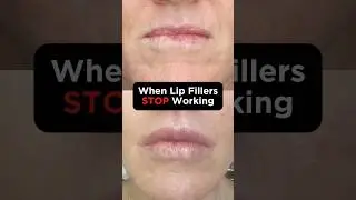 When Lip Fillers STOP Working