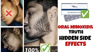 Man Matters Oral Minoxidil 2.5mg | Man Matters Minoxidil tablets review | minoxidil beard growth |
