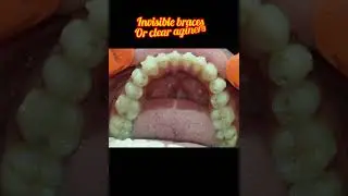 #clearaligner #invisiblebraces #alignersforteeth #bracesjourney #braces #smilemakeover #smiledesign
