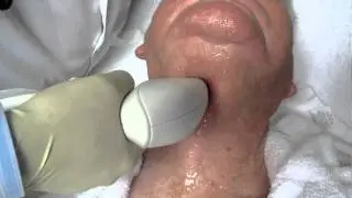 Facial Skin Tightening using Viora Reaction RF CORE