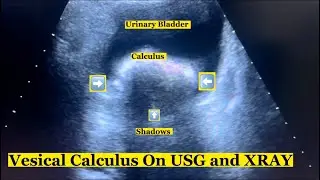 Vesical Calculus On Ultrasound And Xray | Case No 7 #urinarybladder #ultrasoundscans #xrayclasses