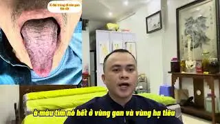 Ung thư đại tràng | khám bệnh online qua lưỡi