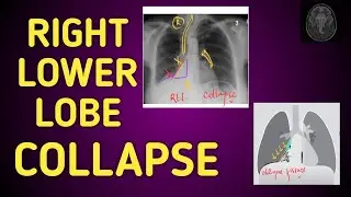 Describing RIGHT LOWER LOBE Collapse on chest xray!